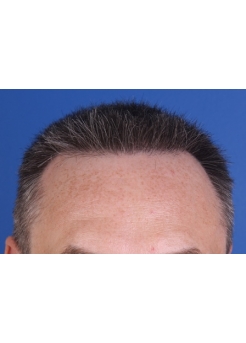 After Hair Transplant&nbsp;2 Sessions (Areas)